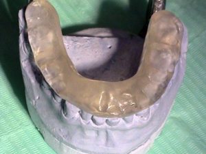 Prosthetics - treatment of temporomandibular joint diseases - Stonek - MUDr. Jan Kucera