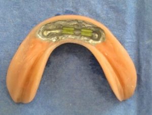 Treatment of edentulous jaw - Stonek dentistry - MUDr. Kucera Jan