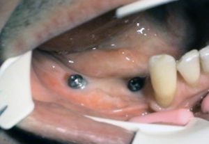 Implantation of posterior edentulous sections in jaw - Stonek Kosice