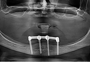 X-ray of implant in Stonek dental clinic Košice - MUDr. Kučera Ján