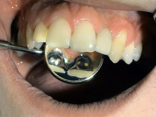 Prosthetics - Stonek Kosice - adhesive bridges