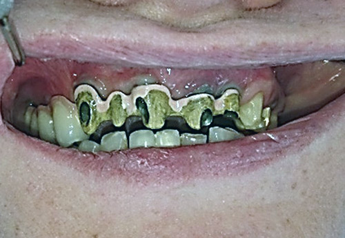 Implants - dental clinic Košice - Kučera Ján