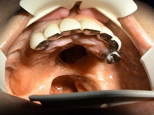 Prosthetic rehabilitation of post-oncological conditions Stonek Kosice