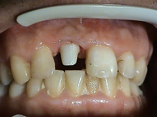 Proteticke riesenie v implantologii