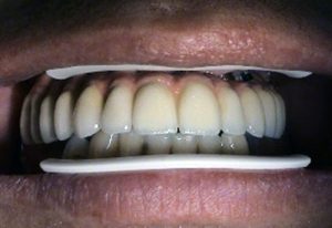 Implantology of dental clinic Košice - Kučera Ján