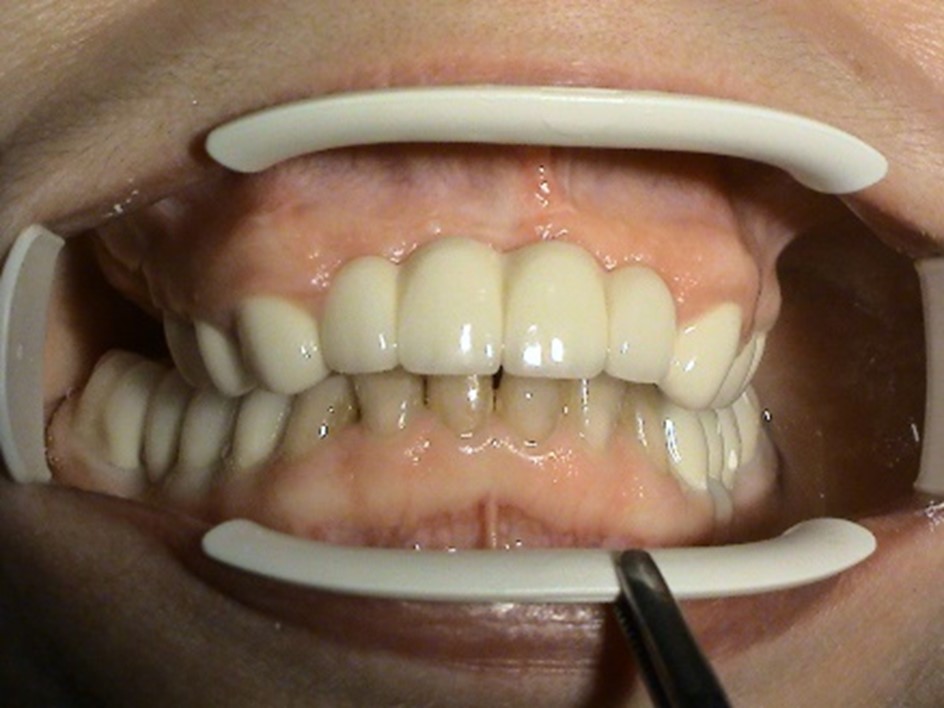 Prosthetic rehabilitation of destroyed bites