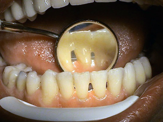 Prosthetics - adhesive bridges - dentist Kosice - MUDr. Jan Kucera