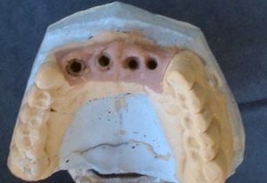 Solution for frontal defect in maxilla - Stonek dentistry Kosice - MUDr. Kucera Jan