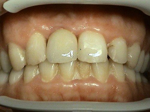 Proteticke riesenie implantologie - Stonek