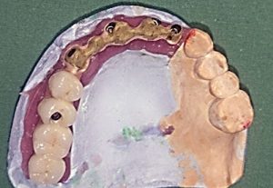 Prosthetic solutions - implantology Stonek Košice