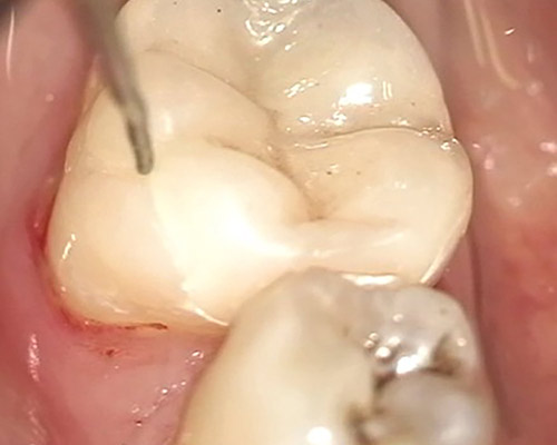 Root canal treatment – Stonek, Dr. Kucera Kosice