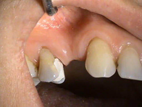 Prosthetic solution in implantology – Stonek