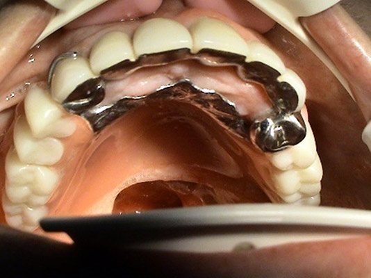 Prosthetic rehabilitation of post-oncological conditions dentist Kosice MUDr. Jan Kucera