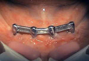 Placement of implant in Stonek dental clinic Košice - MUDr. Kučera Ján