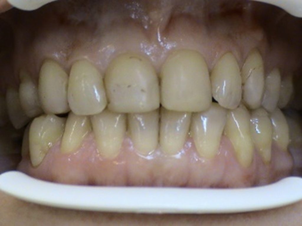 Reconstructions with ceramic veneers STONEK