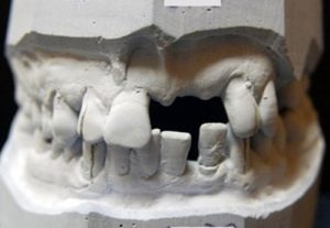 Frontal defect in maxilla - implantology Kosice - MUDr. Kucera Jan