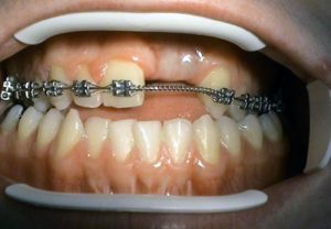 Implant solutions for orthodontic defects - Stonek dentistry Košice