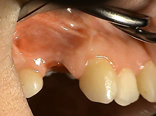 Replacements of missing teeth – Stonek