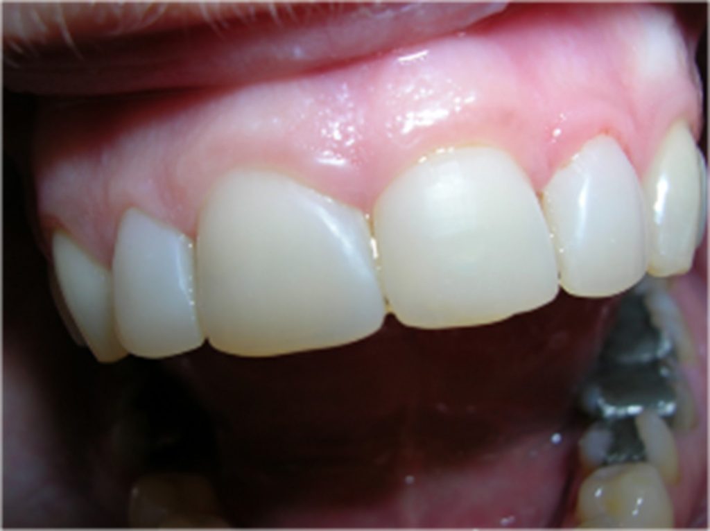 Composite reconstructions Stonek Clinic Kosice