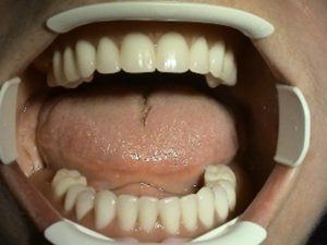 Treatment of edentulous jaw - 4 implants - Stonek dentistry Košice