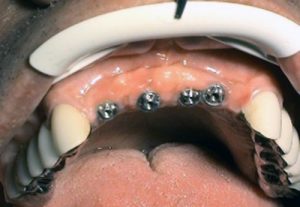 Implantology Stonek Košice - MUDr. Kucera Jan - Kriva 23