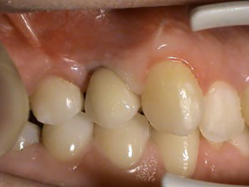 Replacements of missing teeth – Implantology Stonek