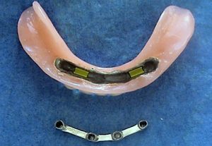 Bicortical implants - dentist MUDr. Kučera Ján PhD. Košice