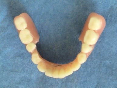 Immediate implantation and prosthetics - all in one - implantologist Kucera Jan - Kosice