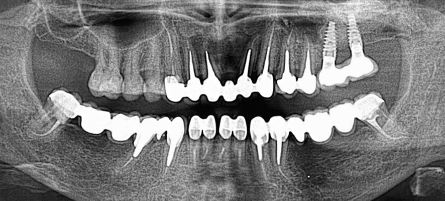 Root canals, dental caries - Stonek Kosice dentist Dr. Kucera