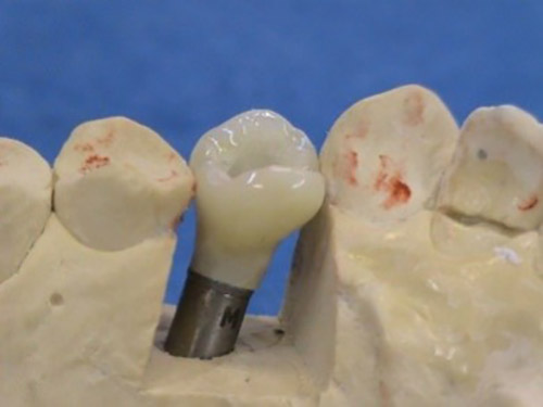 Replacements of missing teeth – Stonek Kriva 23