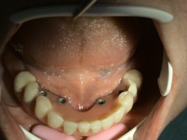 Immediate implantation and prosthetics - all in one - dentistry, implantology Stonek