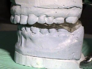 Treatment of temporomandibular joint diseases - Stonek Kosice Slovakia