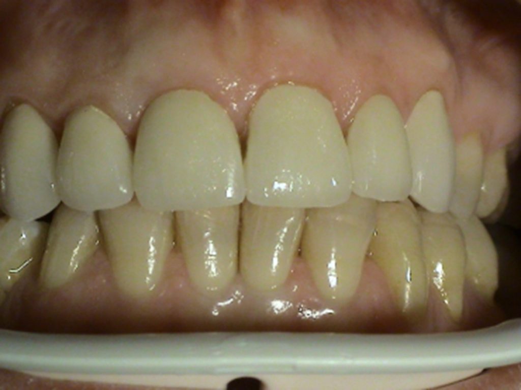 Reconstructions with ceramic veneers Stonek 1