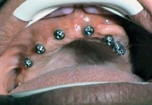 Implantation for edentulism in maxilla - Stonek Kosice Kriva 23