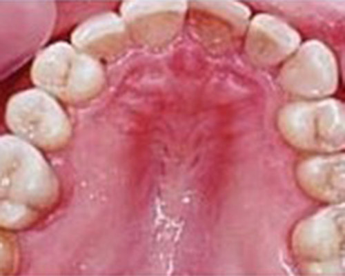 Dental caries – dentist Kosice – Stonek s.r.o. – Jan Kucera