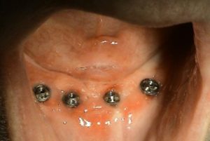 Treatment of edentulous jaw - 4 implants - STONEK Košice