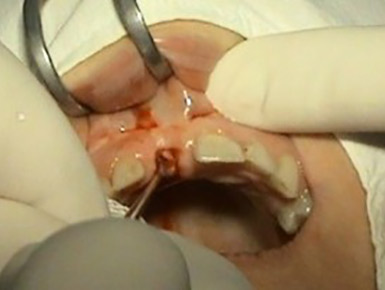 Immediate implantation and prosthetics - Stonek