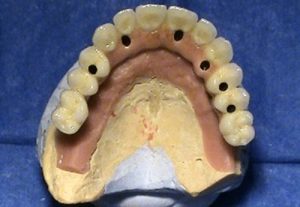 Implantology of Stonek dental clinic in Košice