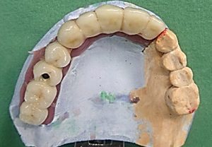 Prosthetics in implantology - implants Stonek Košice