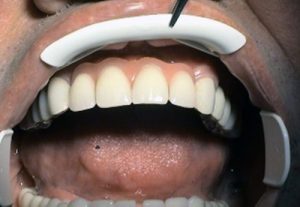 Solution for frontal defect in maxilla - implantology Kosice - Kucera Jan